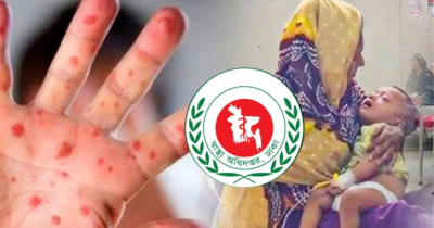 হামের উপসর্গে আরও ৮ মৃত্যু, মোট প্রাণহানি ১,১১৮