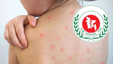 হামের উপসর্গে আরও ৫ মৃত্যু, এ বছর প্রাণহানি ১২০১